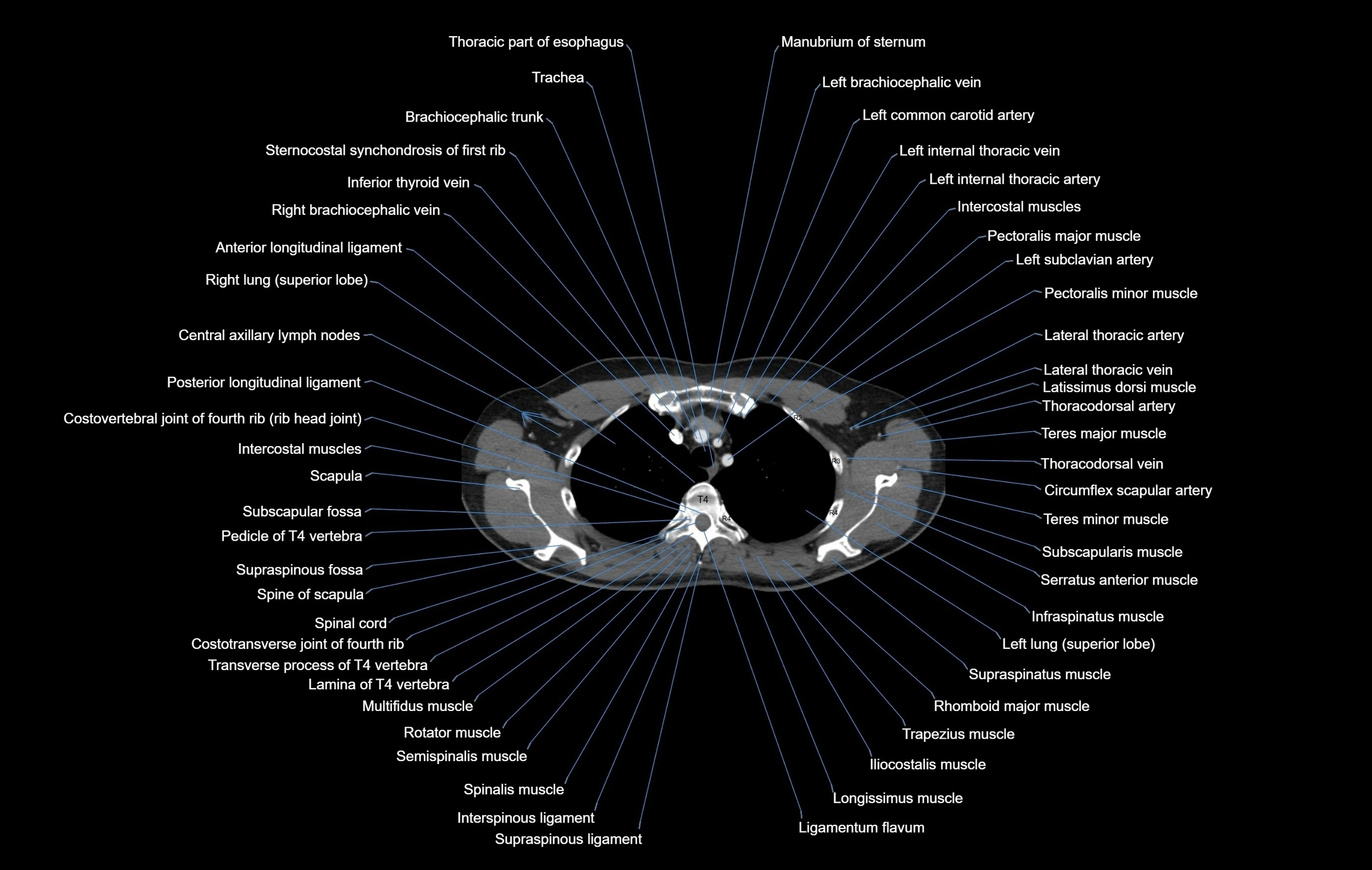 CT chest (thorax) soft tissue window labelled axial cross sectional anatomy radiology image-00026.webp